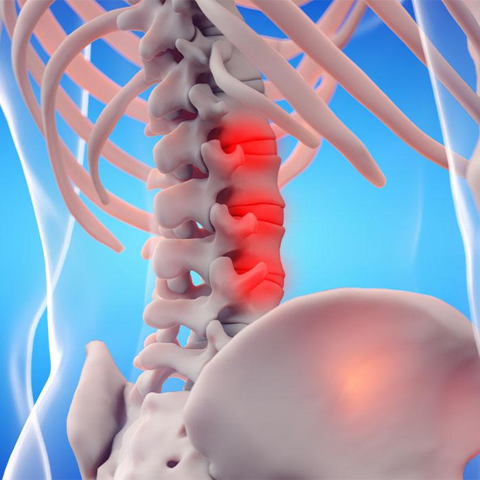 ankylosing spondylitis chiropractor in Marlton NJ