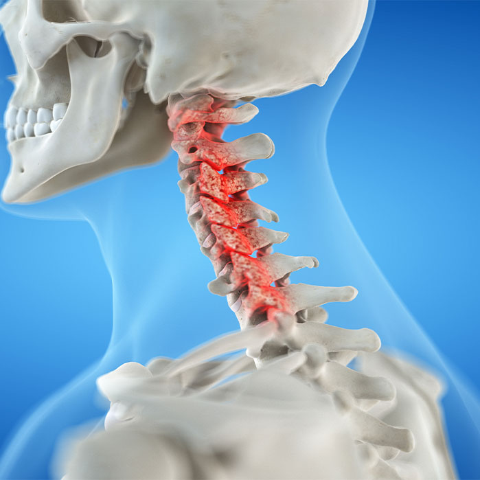 bone spur treatment in Marlton NJ