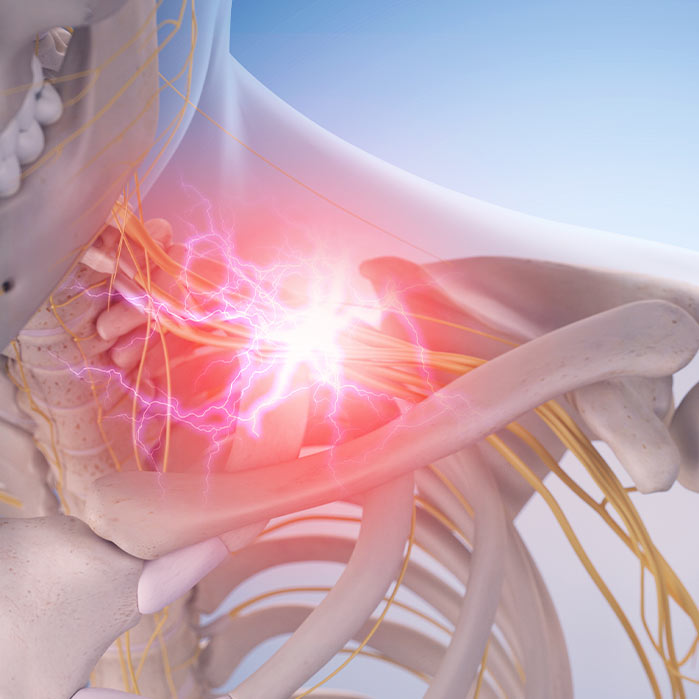 brachial plexus neuritis relief in Marlton NJ