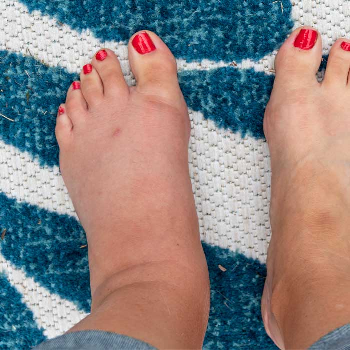 complex regional pain syndrome relief in Marlton NJ