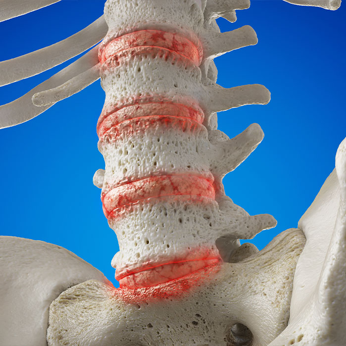 degenerative disc disease treatment in Marlton NJ