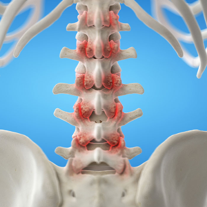 facet joint syndrome treatment in Marlton NJ