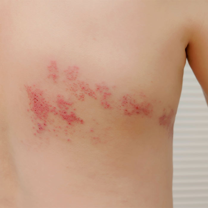 post herpetic neuralgia relief in Marlton NJ