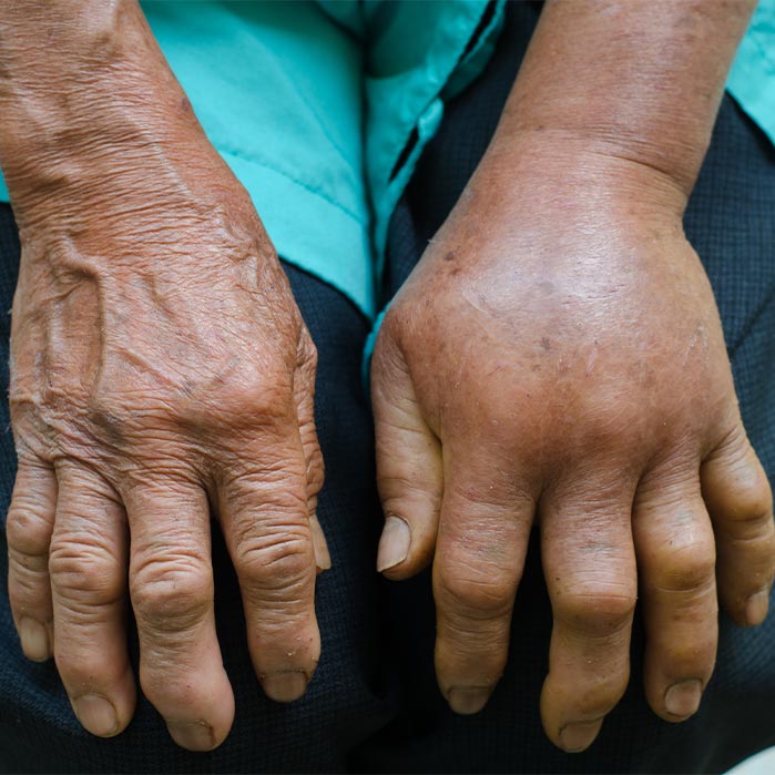 reflex sympathetic dystrophy relief in Marlton NJ