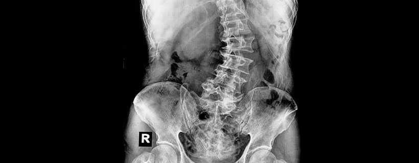 patient needing scoliosis treatment in Marlton
