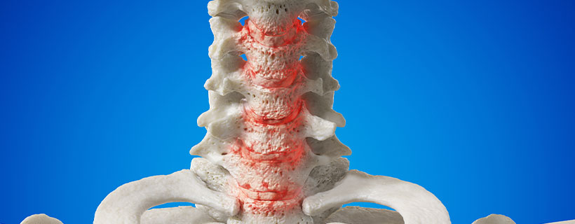 patient needing spondylosis treatment in Marlton