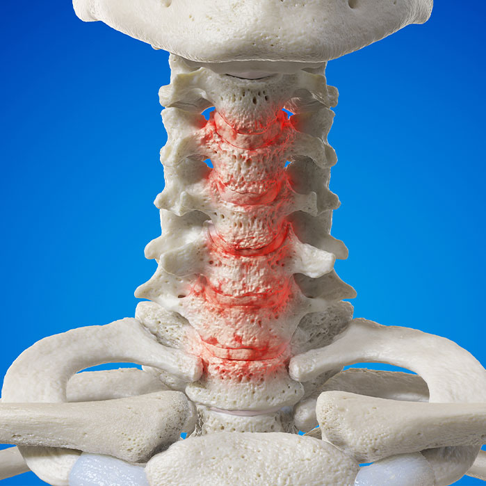 spondylosis treatment in Marlton NJ