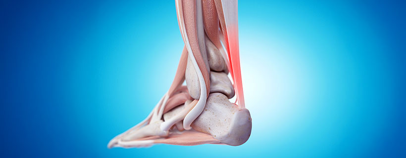 patient needing tendonitis treatment in Marlton