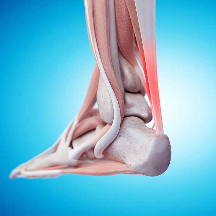 tendonitis chiropractor in Marlton NJ